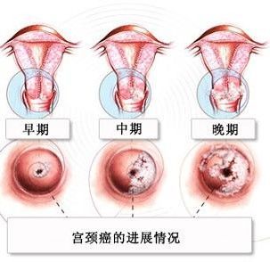 宫颈癌是怎样一步一步形成的?